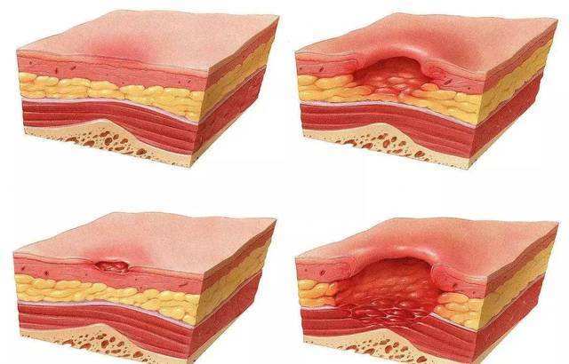 褥疮疾病进展分期全解析：揭秘最新分期标准与治疗策略